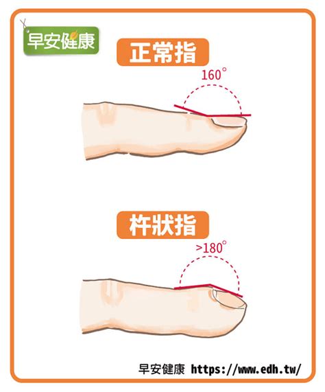 忤狀指|杵狀指是心肺在求救！醫教2招手指檢測，手指一靠找。